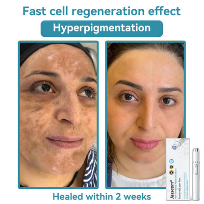 𝐉𝐚𝐬𝐬𝐞𝐞𝐦® Medical-Grade Laser Pen 🏆 (Powered by CO₂ laser technology – effectively removes moles, warts, skin tags, pigmentation spots, and other skin imperfections)🔥