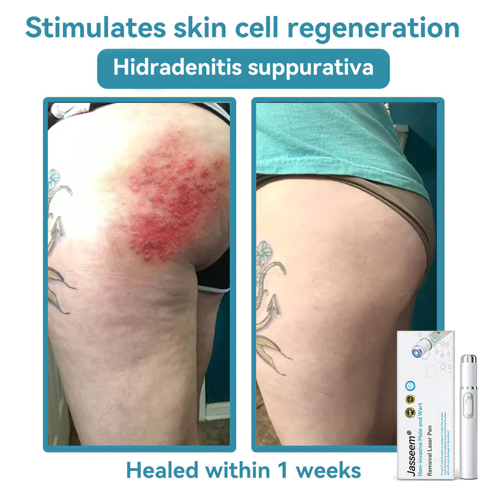 𝐉𝐚𝐬𝐬𝐞𝐞𝐦® Medical-Grade Laser Pen 🏆 (Powered by CO₂ laser technology – effectively removes moles, warts, skin tags, pigmentation spots, and other skin imperfections)🔥