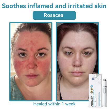 𝐉𝐚𝐬𝐬𝐞𝐞𝐦® Medical-Grade Laser Pen 🏆 (Powered by CO₂ laser technology – effectively removes moles, warts, skin tags, pigmentation spots, and other skin imperfections)🔥