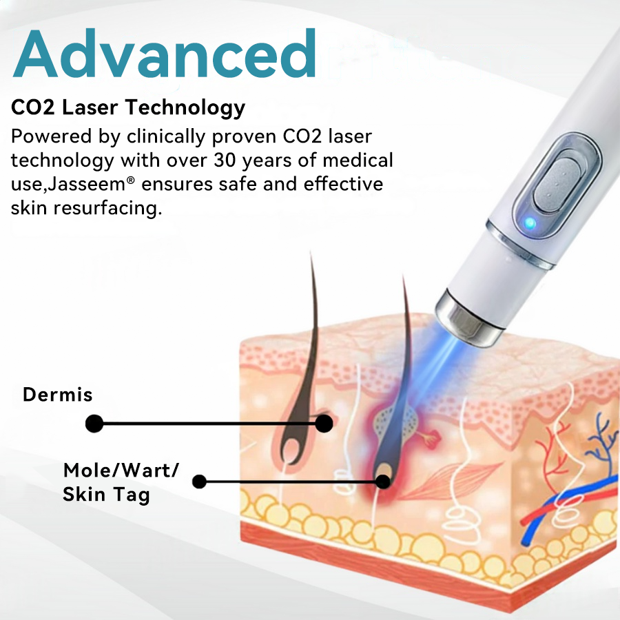 𝐉𝐚𝐬𝐬𝐞𝐞𝐦® Medical-Grade Laser Pen 🏆 (Powered by CO₂ laser technology – effectively removes moles, warts, skin tags, pigmentation spots, and other skin imperfections)🔥