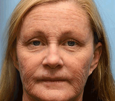 STDEI® BOTOX & VITA A RETINOL SHOT Anti-Wrinkle Lifting & Firming Cream🎁🎁